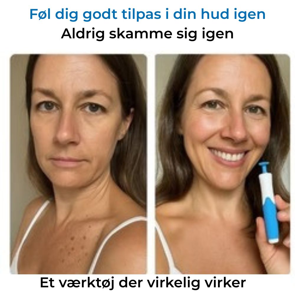 DermSwiftkit™ - Fjern hudmærker nemt derhjemme!